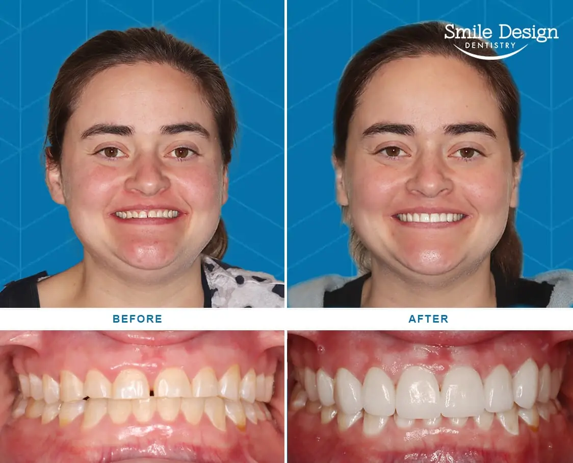 Before After Image
