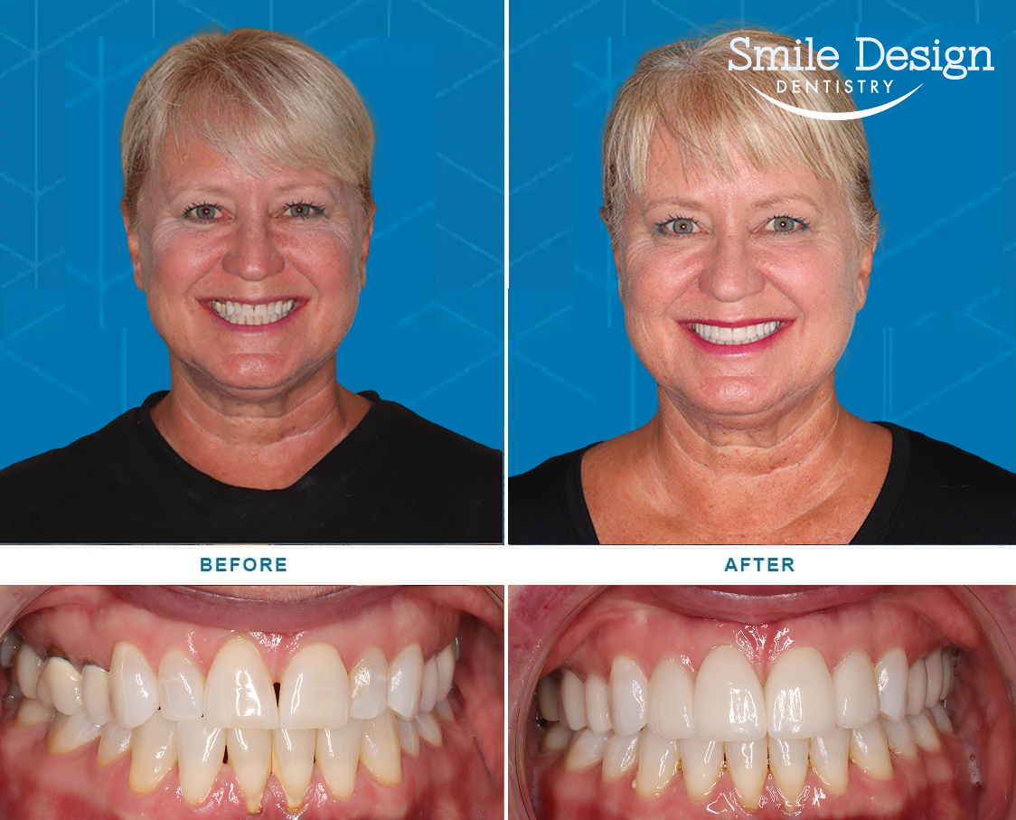 Before After Image