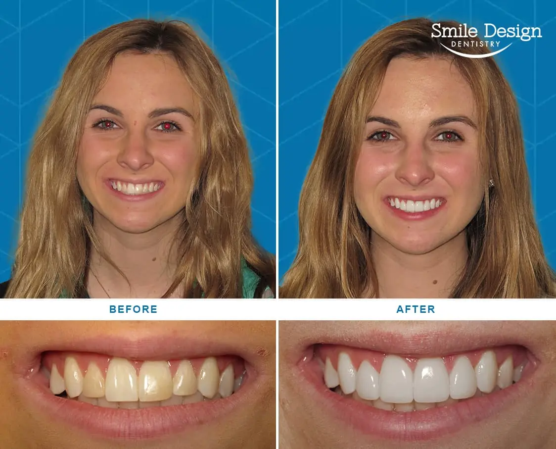 Before After Image