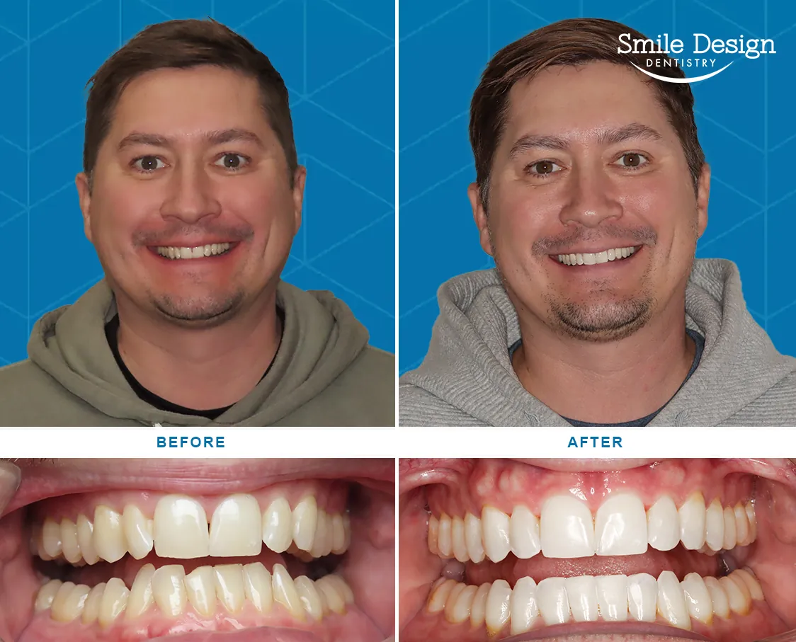 Before After Image