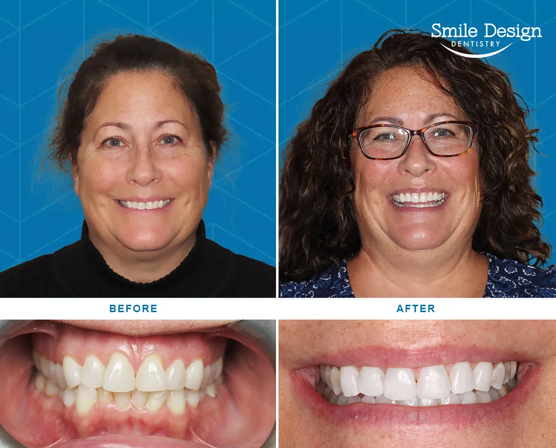 Before After Image